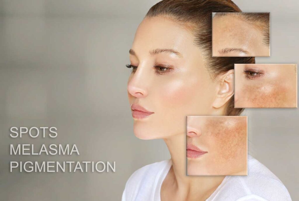 Pigmentvlekken. Meer dan een schoonheidskwestie